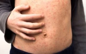 Surgen más casos de sarampión en Coahuila; Secretaría de Salud reporta ocho contagios