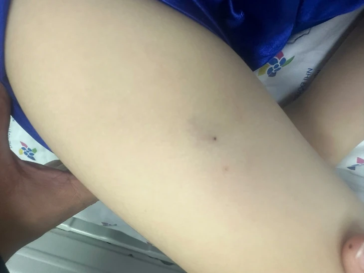 Bé 3 tuổi bị sốc phản vệ độ 3 vì ong đốt