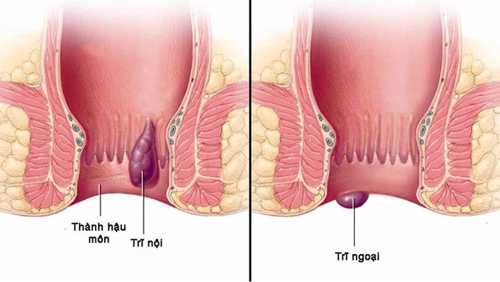 5 thủ phạm ‘giấu mặt’ gây ra nỗi ám ảnh mang tên bệnh trĩ