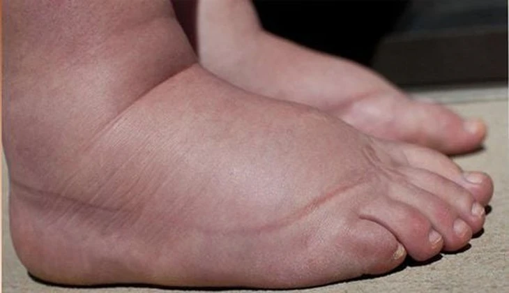 Trẻ đột nhiên bị phù, coi chừng mắc bệnh lý thận nguy hiểm