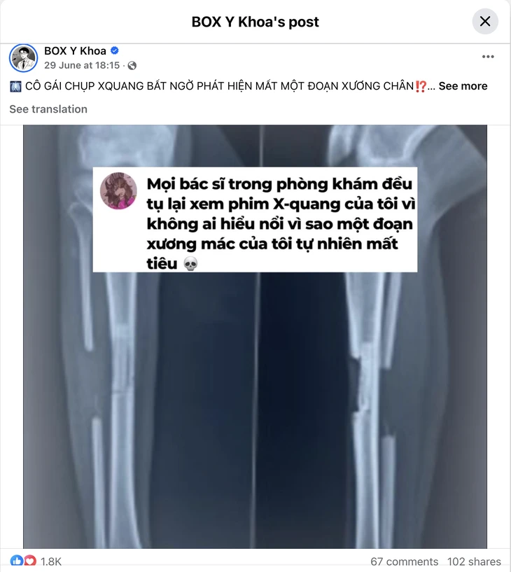 Cô gái chụp X-quang bất ngờ thấy mất xương chân