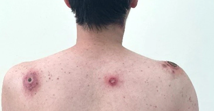 Vết loét tự lành: Dấu hiệu cảnh báo bệnh giang mai?