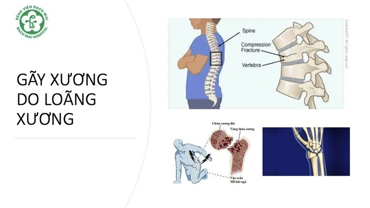 Loãng xương - căn bệnh bị xem nhẹ nhưng tỉ lệ tử vong cao