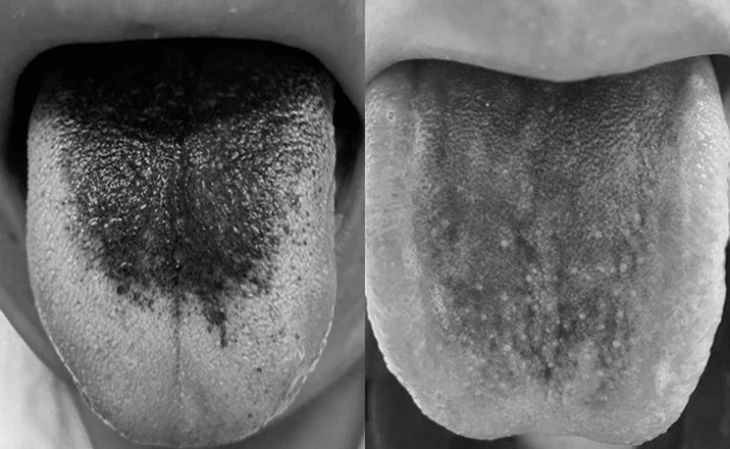 Lưỡi đen bất thường có phải bệnh nguy hiểm?