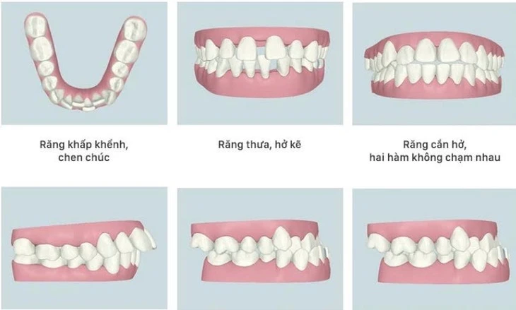 Hai lợi ích ít được biết đến của việc niềng răng