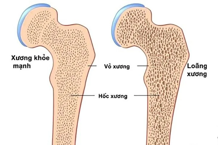 Làm gì để phòng ngừa bệnh loãng xương?