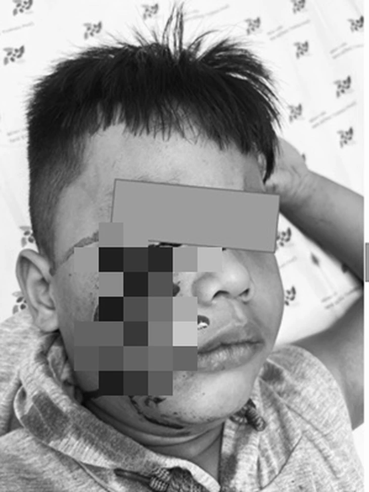 Bé 5 tuổi bị chó cắn hàng chục vết thương sâu ở mặt, phải khâu 20 mũi