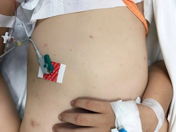 Ca mắc não mô cầu phía Nam tăng cao, nguy cơ xuất hiện thêm ca bệnh cộng đồng