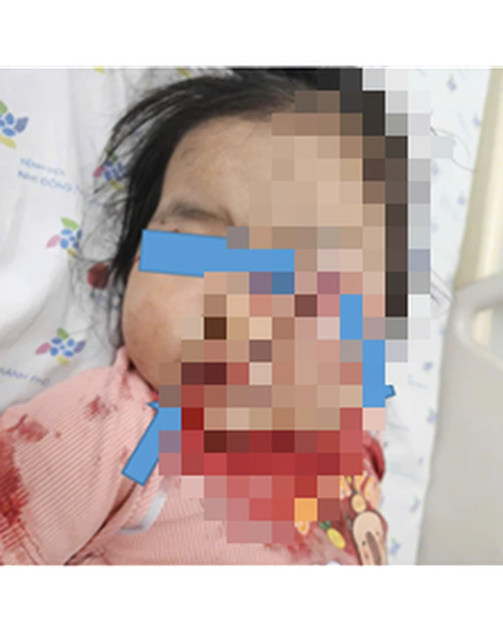 Bé gái 2 tuổi bị dập phổi, rách mặt do vặn tay ga xe máy vừa dừng trước cửa nhà