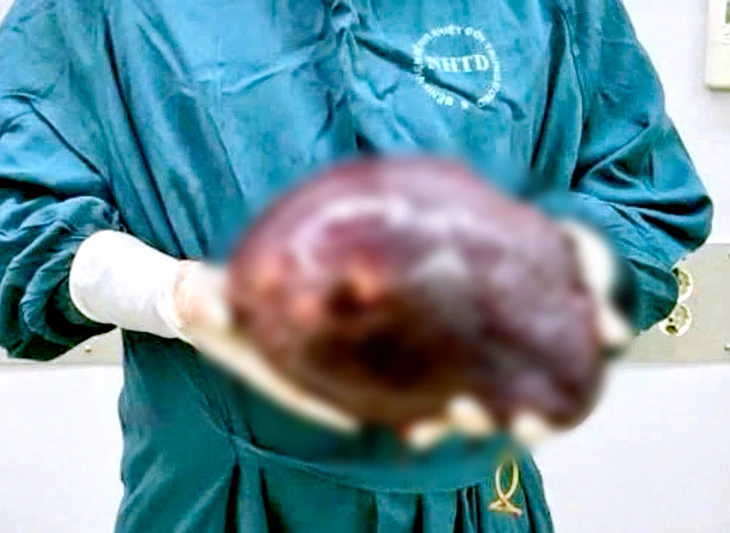 Cắt khối u gan khổng lồ nặng 2,5kg