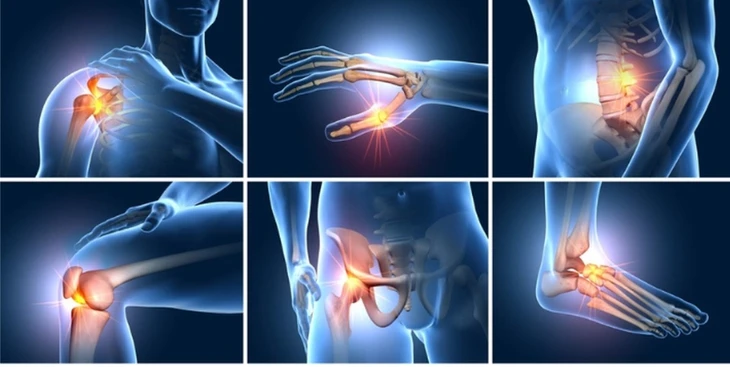 Thoái hóa khớp giai đoạn sớm: Nên bắt đầu bằng thuốc bôi tại chỗ và tập luyện