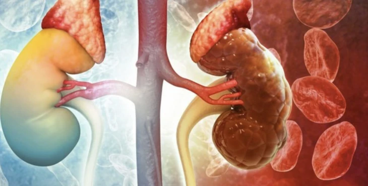 18 tuổi đã bị hỏng thận vì thói quen ăn uống