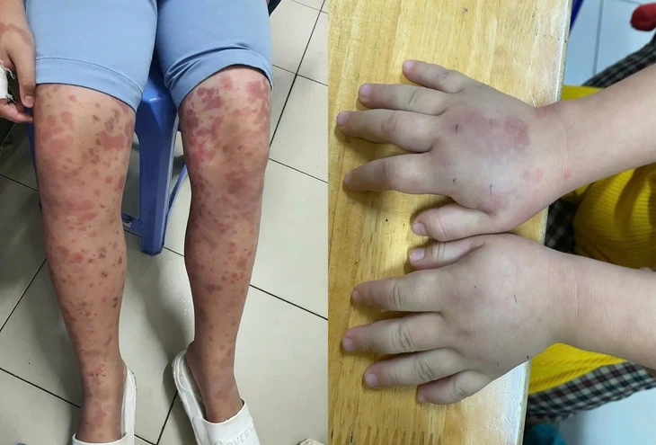 Cảnh báo bệnh ban xuất huyết Schonlein - Henoch gây biến chứng thận nguy hiểm ở trẻ em