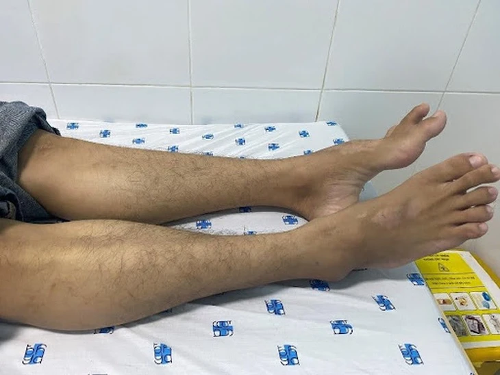 Tê yếu chi dưới lâu ngày có thể là biểu hiện của bệnh hiếm?