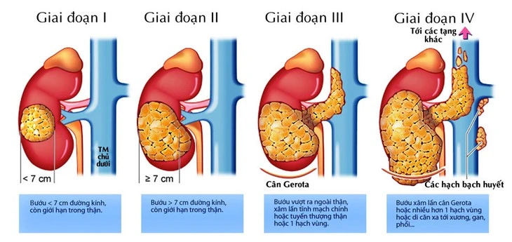 Ung thư thận: Xu hướng gia tăng đáng báo động