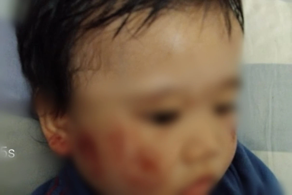 Balita 1 Tahun Terluka Saat Dititipkan di Daycare Surabaya, Pipi Lebam Seperti Digigit