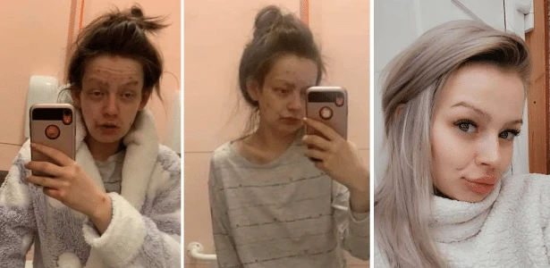 Mãe de 27 anos mostra antes e depois de vencer luta contra a heroína; veja