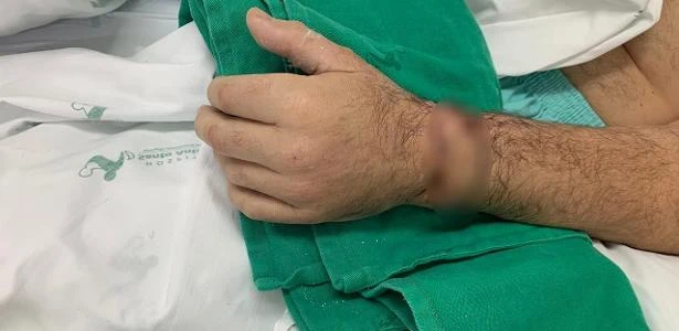 SC: Homem tem mão reimplantada após aprender a preservá-la em séries de TV