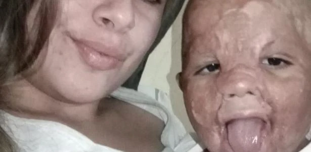 Família faz campanha por roupa para menino que teve 100% do rosto queimado