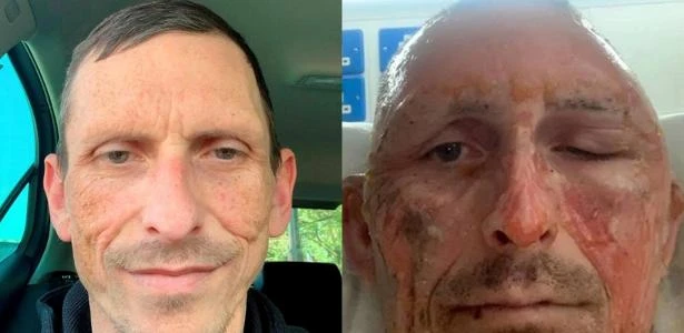 Taxista sofre queimaduras após passar álcool em gel e acender isqueiro