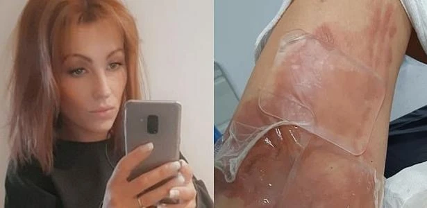 Mulher sofre queimaduras após copo de chocolate quente do McDonald's abrir