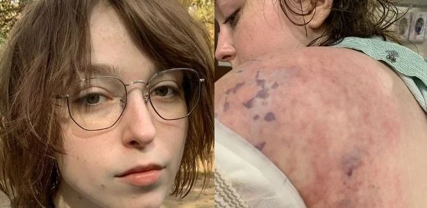Jovem contrai infecção rara através de bomba de insulina de diabetes