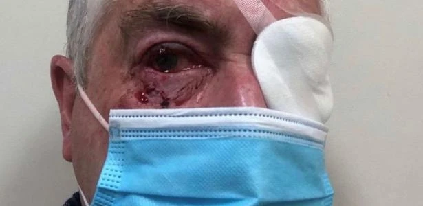 Idoso é atacado por pássaro na Austrália e quase perde visão após bicadas