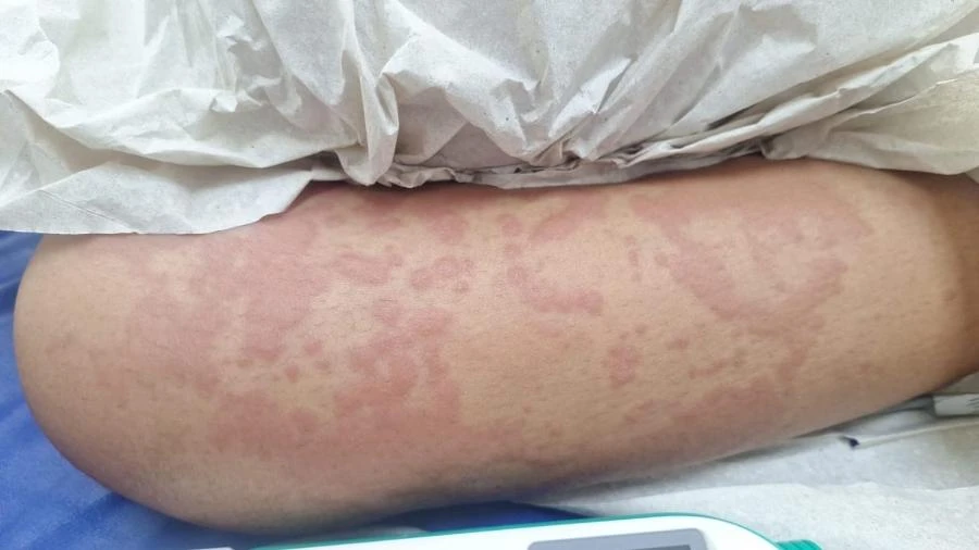 RN: Exame em menina que foi internada descarta contaminação por detergente Carlos Madeiro