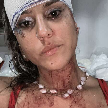 Mulher diz ter sofrido agressão policial no Carnaval de Olinda