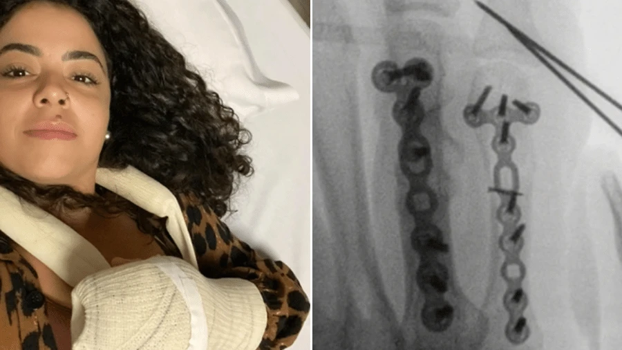 Ela teve fratura brincando de cabo de guerra: 'Minha mão foi esmagada'