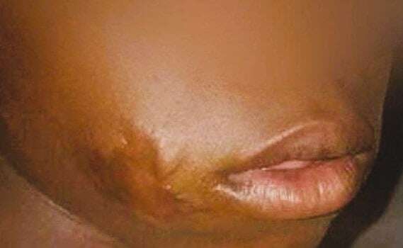 The face scar caused by a rubber bullet that cost police minister R2.3m