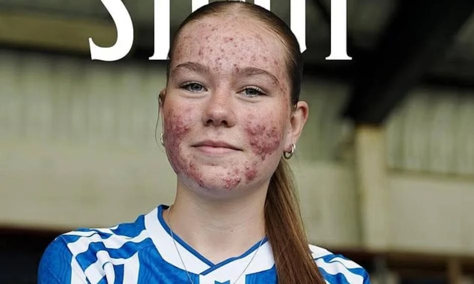 Sokkerwêreld skaar hom agter tiener wat oor haar aknee gespot word