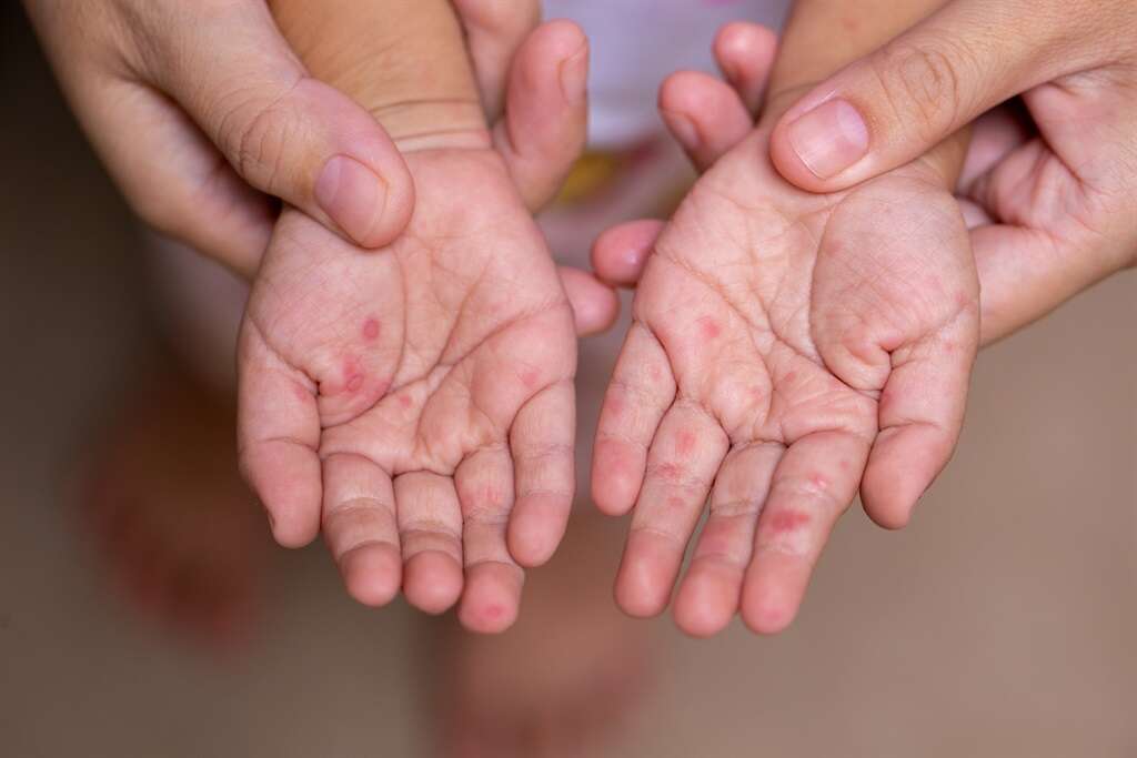 Free State authorities on alert amid suspected hand, foot and mouth disease outbreak at school