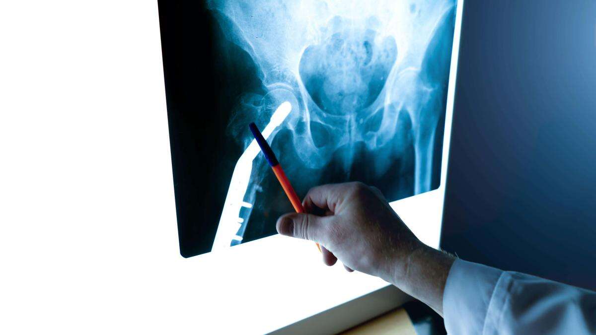 Streeting urged to honour promise to end osteoporosis service postcode lottery