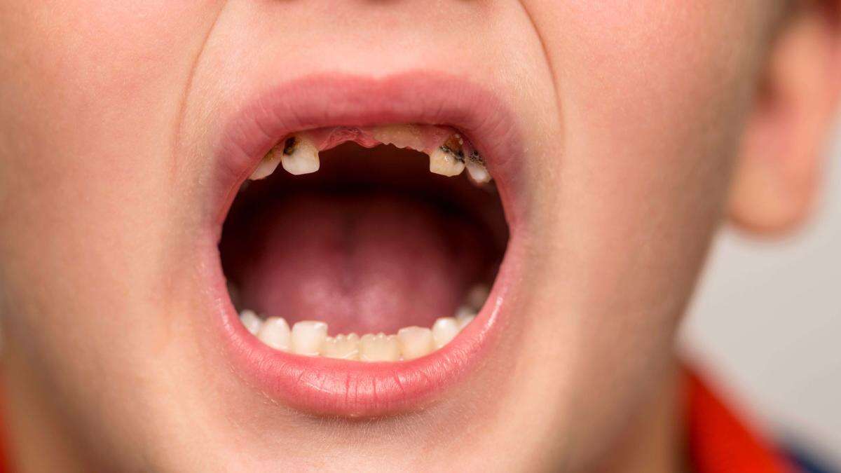 Amount of five-year-olds with rotting teeth rising in parts of England – data