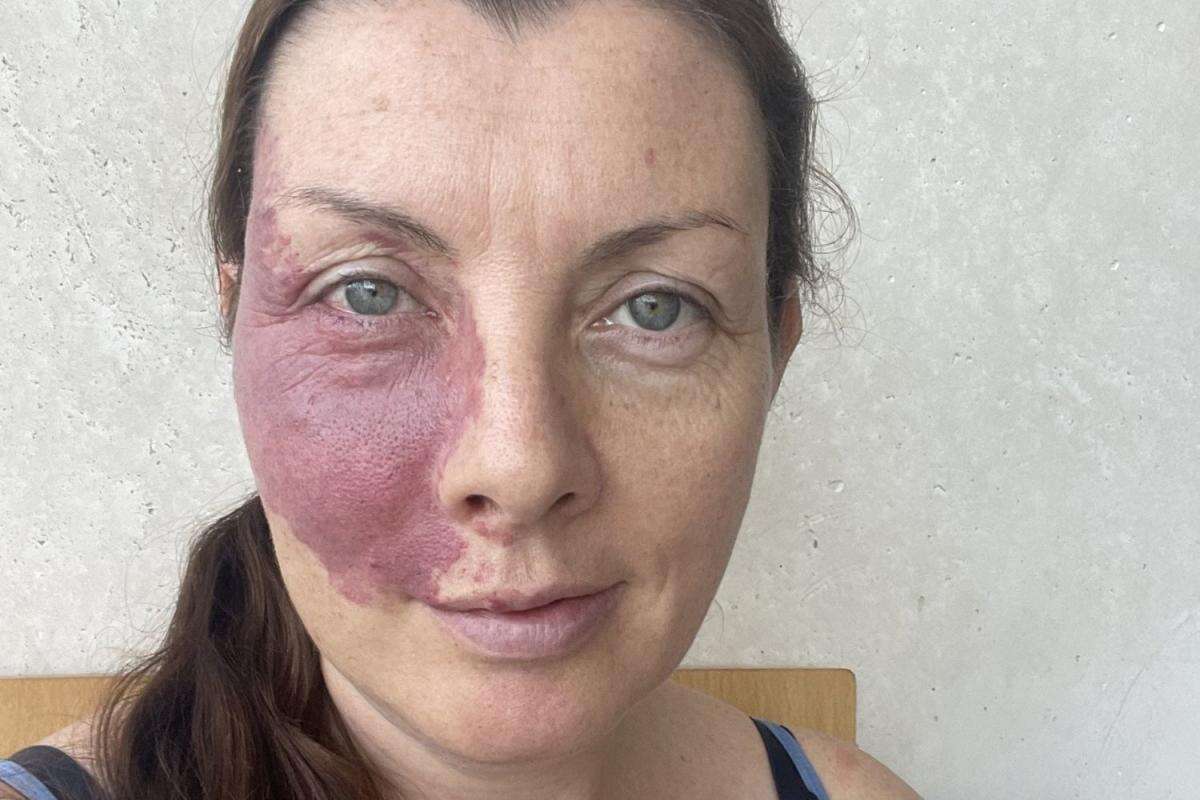 I covered my birthmark for 20 years but having children helped me embrace it