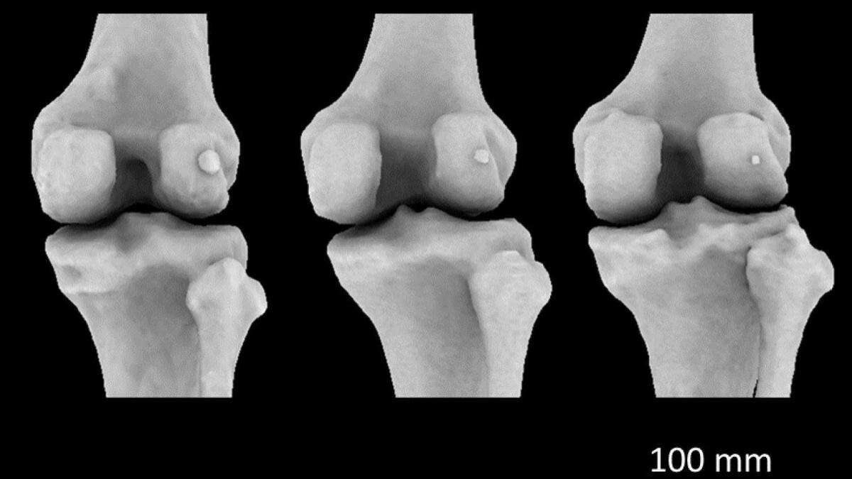 Tiny knee bone linked to osteoarthritis ‘may have helped humans walk upright’