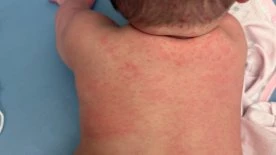 Alberta surpasses all of the United States in confirmed measles cases