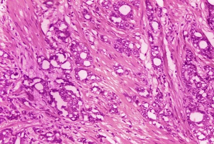 New radiation drug shows improved survival in prostate cancer patients