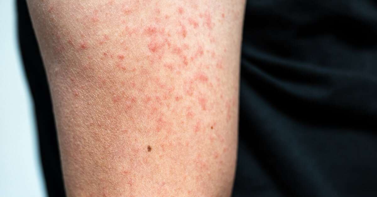 Measles cases in the U.S. are already triple last year’s total, and it’s only July