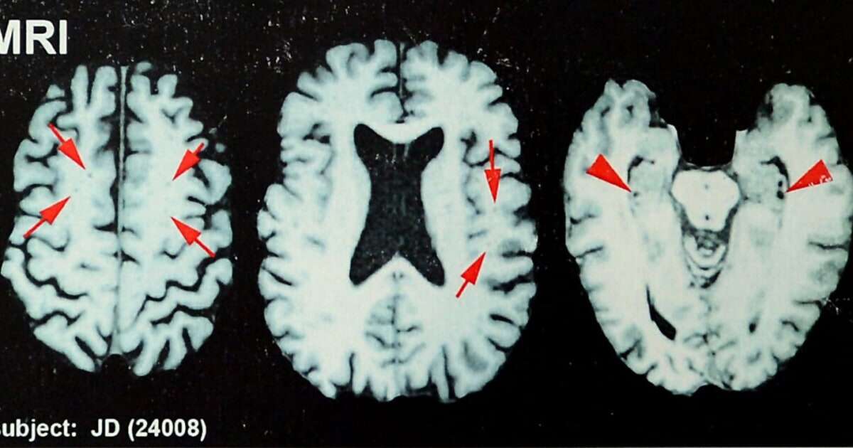 A third of former NFL players surveyed think they have CTE, study suggests