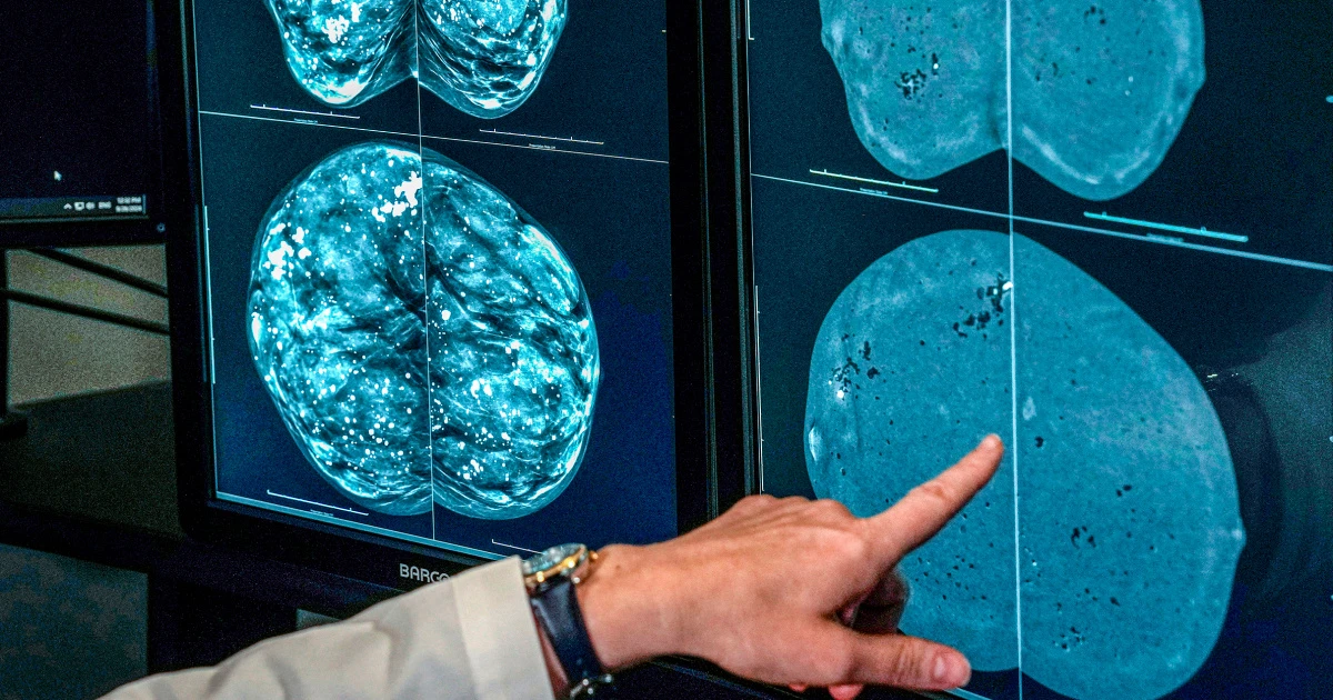 When should you get a mammogram? Conflicting advice makes it hard to know