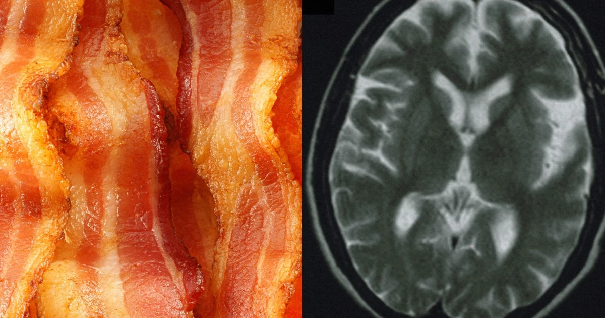 Eating more processed red meat is linked to an increased risk of dementia, study suggests