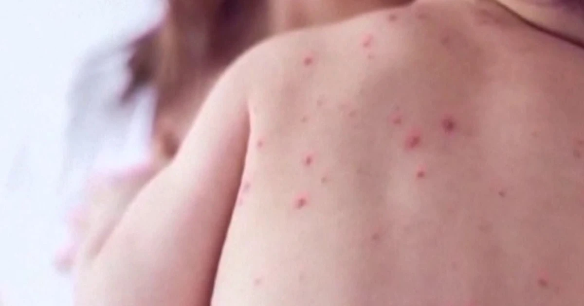 Measles cases on the rise since the start of the year