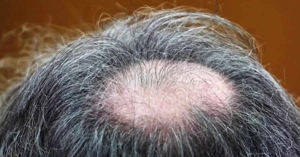 Some doctors worry about rare side effects from taking hair loss prevention drugs