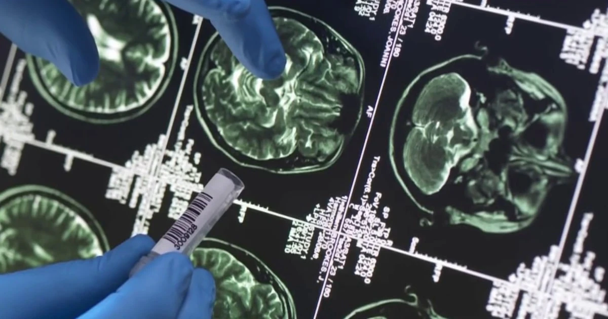 Research shows new blood tests could detect Alzheimer’s disease more accurately
