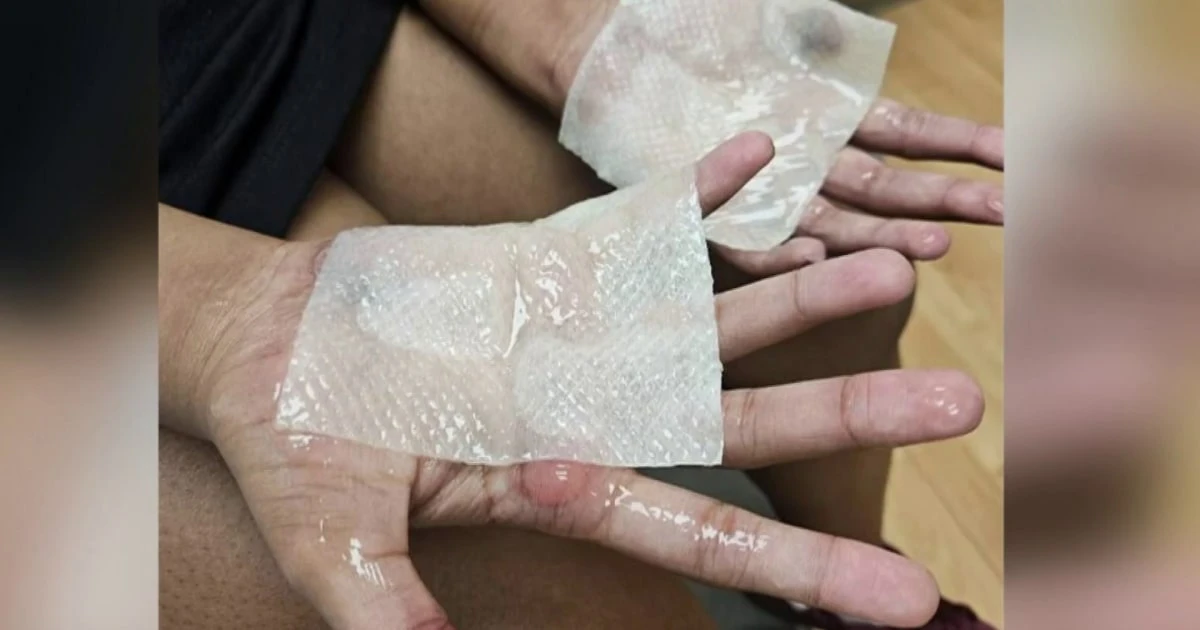 High school dance team member suffers severe burns