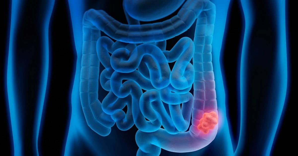 New Study Shows Promising Results in Fight Against Colon Cancer