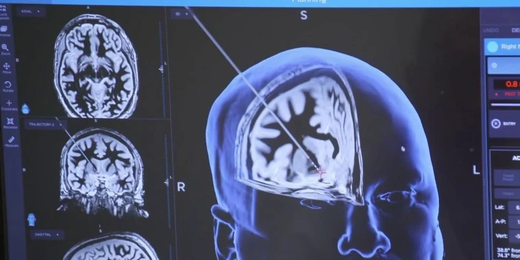 Exclusive: Could innovative brain surgery be tool to treat severe substance abuse?