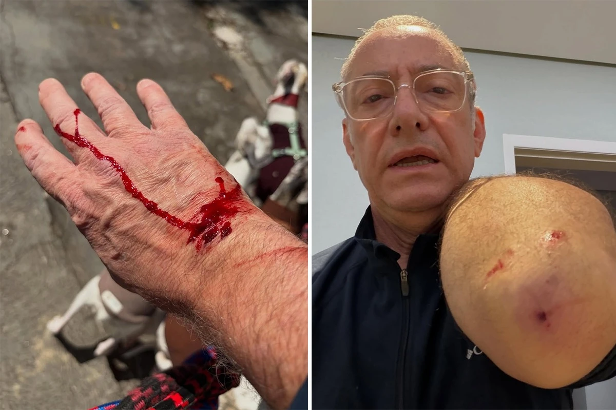 Apresentador da Globo é atacado por pitbull: ‘Ele avançou e feriu a mim e a uma das minhas cachorras’